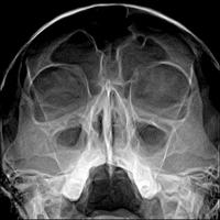 Рентгеновский снимок черепа и пазух
