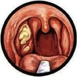 Язвенно-пленчатая (некротическая) ангина: симптомы и лечение