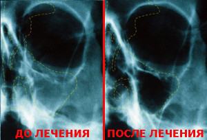 Рентгеновский снимок до и после лечения гайморита