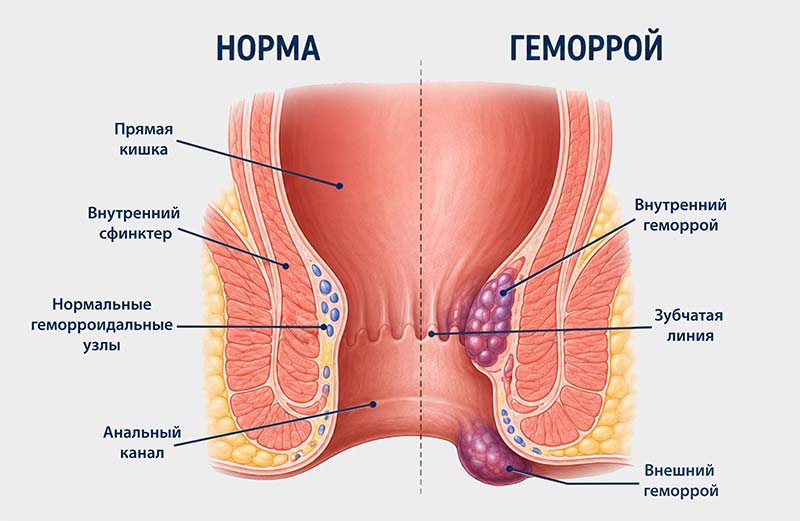 Сравнение нормы и геморроя на схеме прямой кишки
