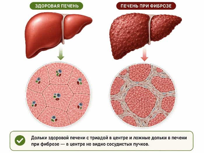 Дольки здоровой печени и ложные дольки печени при фиброзе