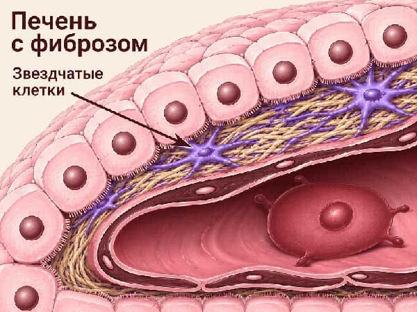 Печень при фиброзе