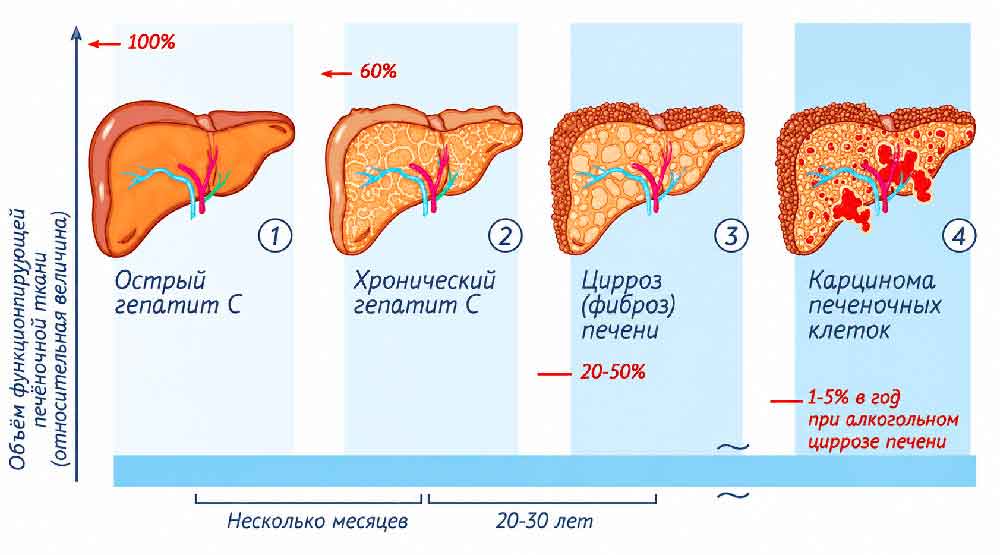 Прогрессирование хронического гепатита через стадию цирроза к развитию гепатоцеллюлярной карциномы