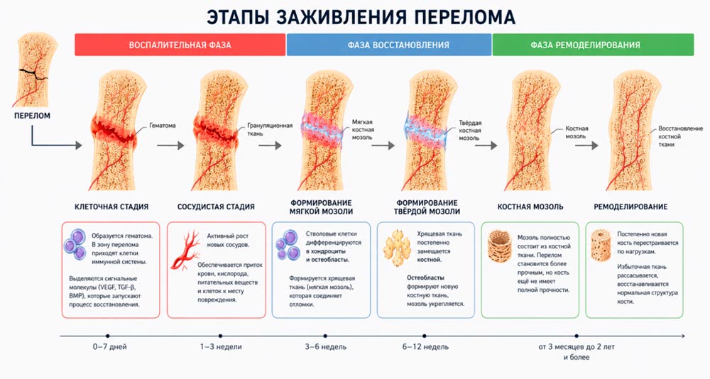 Стадии заживления перелома Этапы заживления перелома