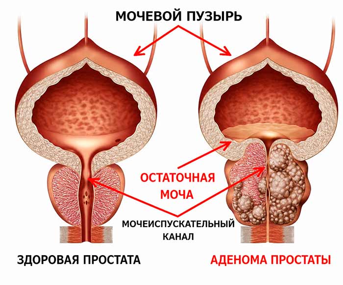 Сравнение здоровой простаты и аденомы простаты