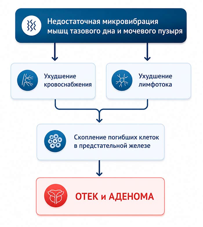 Схема развития аденомы простаты