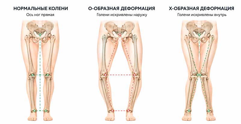 Деформирующий артроз: «x» или «o» деформация в суставах Деформирующий артроз: «x» или «o» деформация в суставах
