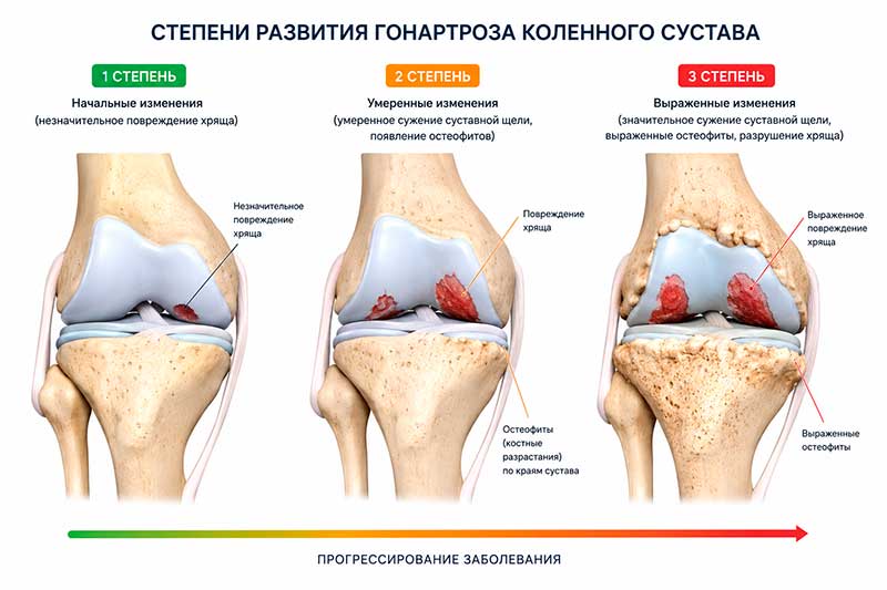 Степени развития гонартроза коленного сустава Степени развития гонартроза коленного сустава