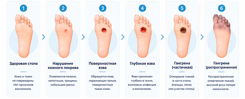 Диабетическая стопа – частое осложнение диабета Диабетическая стопа – частое осложнение диабета