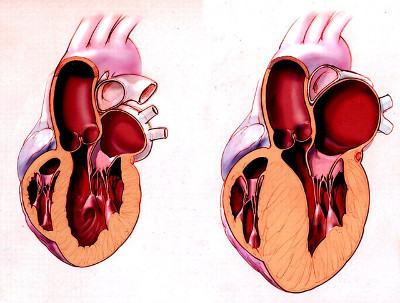 Гипертрофия миокарда (сердечной мышцы) 