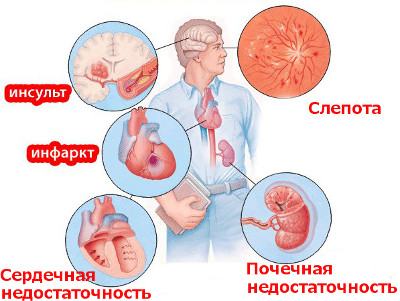 Гипертония: симптомы, признаки и осложнения