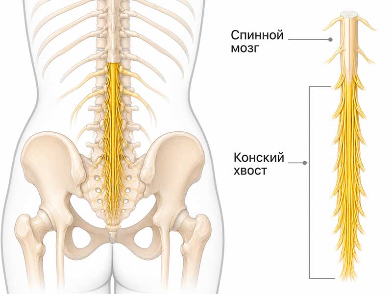 Синдром конского хвоста - сдавление пучка нервных волокон
