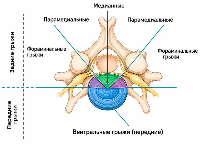 Виды межпозвоночных грыж