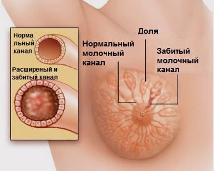 Причины лактостаза