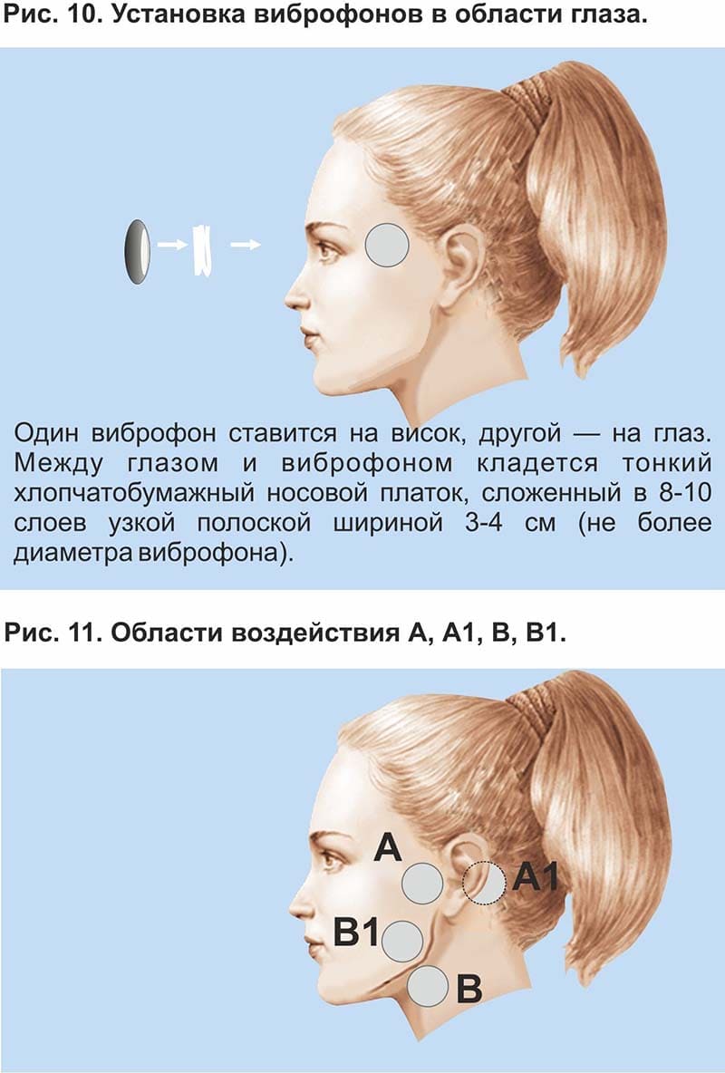 Области воздействия А, А1, В, В1