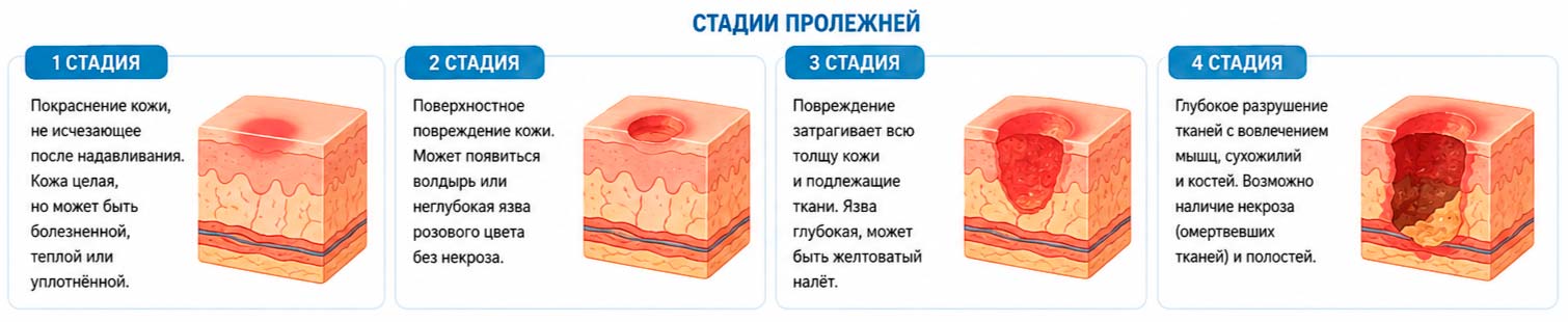 Стадии пролежней 4 стадии пролежней
